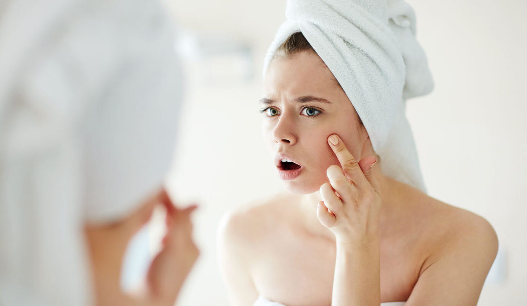 Acne giovanile: cos’è e come intervenire